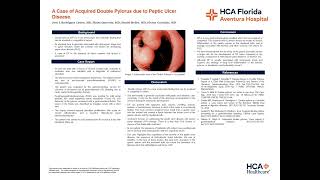 A Case of Acquired Double Pylorus due to Peptic Ulcer Disease [upl. by Saundra]