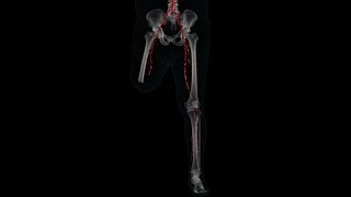 AngioTomografía de Miembros Inferiores  Paciente con Pie Diabético  Amputación de Pierna Derecha [upl. by Sulienroc]