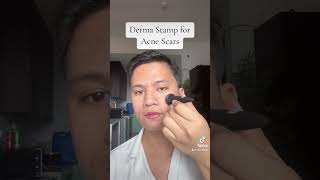 Derma Stamp for ACNE SCARS reels skincare acnetreatment acnejourney skincareroutine acnes [upl. by Leitao]