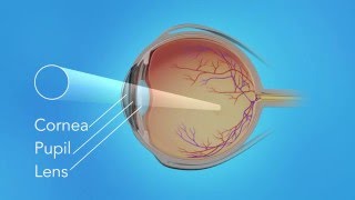 Detached Retina Pneumatic Retinopexy [upl. by Ydwor]