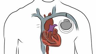 Difference Between Cardioversion and Defibrillation [upl. by Thibaut629]