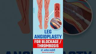 Opening Blocked arteries of Legs with Balloon Angioplasty youtubeshort legAngioplasty shortsfeed [upl. by Abagail]