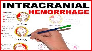 Intracranial Hemorrhage EpiduralSubduralSubarachnoid overview [upl. by Aronow547]