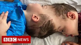 Conjoined twins separated with the help of virtual reality  BBC News [upl. by Marty]