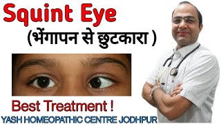 Squint eye treatment  strabismus crossed eye treatment without surgery  भेंगापन से छुटकारा [upl. by Simone148]