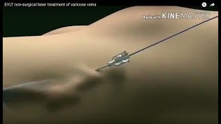 EVLT Laser Treatment for Varicose Veins The Future of Varicose Vein Treatment Animation Video [upl. by Aisanahta]