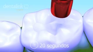 RESTAURACIÓN dental con resina  Video 3D paso a paso [upl. by Aihsinyt]