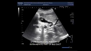 A Stone in the Bile duct called Choledocholithiasis [upl. by Acinahs]