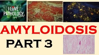 AMYLOIDOSIS PART 3 Morphology Diagnosis Special stains clinical features amp Prognosis [upl. by Sparhawk]