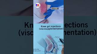 Knee Gel Injections Viscosupplementation shorts medicineknowledgehindi [upl. by Lurlene]