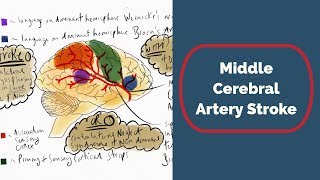 Middle Cerebral Artery Stroke [upl. by Adila396]