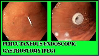 Percutaneous Endoscopic Gastrostomy PEG Tube Deployment  SQUARE HOSPITALS LTD Dhaka BDENDOSCOPY [upl. by Ycaj]