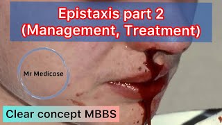 Epistaxis part 2 Management Treatment [upl. by Prospero282]