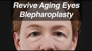 Blepharoplasty Eyelid Surgery to Revive Aging Eyes and Look Years Younger [upl. by Anairda]