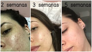 TRATANDO ACNE  Minha experiência com ADAPALENO [upl. by Hairaza596]