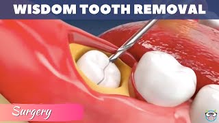 Wisdom teeth removal  Wisdom teeth extraction  Tooth extraction animation [upl. by Renruojos]