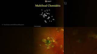 Multifocal Choroiditis Symptoms and Treatment ophthalmology optometry [upl. by Mcginnis502]