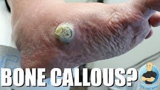 HUGE CALLOUS DUE TO COLLAPSED ARCH EXTREME CALLOUS REMOVAL [upl. by Leaffar279]