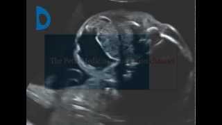 Fetal Medicine Foundation  neck teratoma [upl. by Avin]