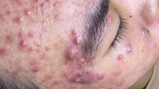 Big Cystic Acne Blackheads Extraction Blackheads amp Milia Whiteheads Removal Pimple Popping  698 [upl. by Pawsner]