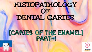 HISTOPATHOLOGY OF DENTAL CARIES  CARIES IN THE ENAMEL PART1 [upl. by Ingamar477]