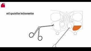 Nasennebenhöhlen OP  FESS  chronische Sinusitis [upl. by Dunaville]