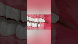 Wisdom tooth problem dentist oralhealth [upl. by Chabot339]