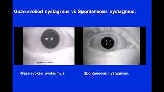 Gaze Nystagmus vs Spontaneous Nystagmus [upl. by Aerdnwahs]