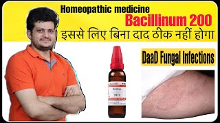 Best Homeopathic Medicine for Fungal Infection Ringworm or tinea corporis  Bacillinum 200 [upl. by Nayek238]