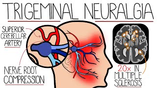 Understanding Trigeminal Neuralgia [upl. by Nagram521]