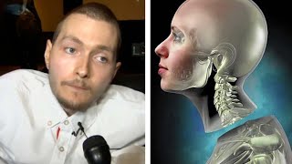 What Happened To The First Human Head Transplant Feat Medlife Crisis [upl. by Anirdnaxela470]