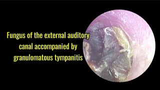 Fungus of the external auditory canal accompanied by granulomatous tympanitis [upl. by Anstus557]