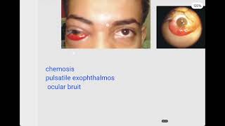 Carotid Cavernous FistulaCCFOphthalmology [upl. by Assenat]