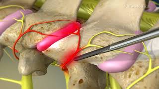 What is Cervical Facet Radiofrequency Neurotomy [upl. by Anerev360]