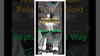 Vertical subantral Sinus Lift with Densah Burs after an Incomplete Lateral Wall Sinus Lift versah [upl. by Cirderf]