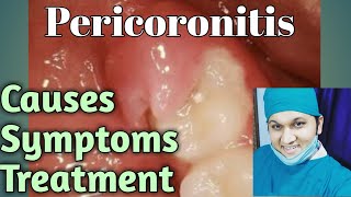 Pericoronitis Types Causes Signs Symptoms Treatments [upl. by Reld621]