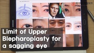 Limit of Upper Blepharoplasty for a sagging eye [upl. by Atirehgram]