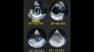 Eyeballing Ejection fraction [upl. by Airbma]