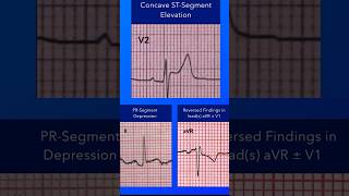 Acute Pericarditis Classic ECG Findings [upl. by Martres]