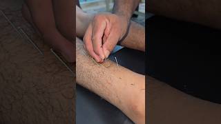 Mid calf pain Acupuncture treatment [upl. by Dubenko]