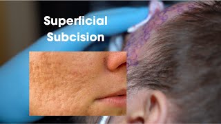 Superficial Subcision Scar Treatment [upl. by Natsud]