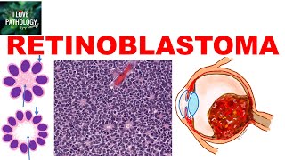 RETINOBLASTOMA Etiopathogenesis Types Clinical features Morphology amp treatment [upl. by Seline]