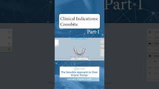 Clinical Indications Crossbite Part 1 [upl. by Amleht]