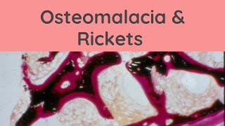 Osteomalacia and Rickets  Pathology mini tutorials [upl. by Aerdnaz]