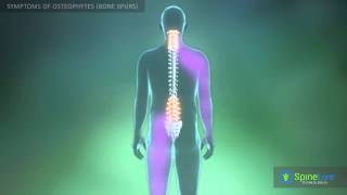 Osteophytes bone spurs Symptoms [upl. by Arabelle728]