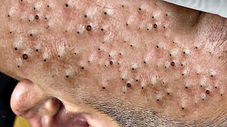 Satisfying Hien Spa Beauty Relaxing Video 102 [upl. by Namijneb756]