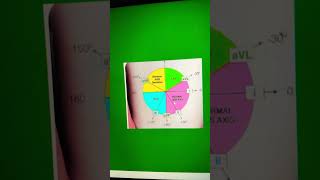 Left axis deviation in ECG [upl. by Hajin]