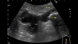 Abdominal aortic aneurysm [upl. by Notned]