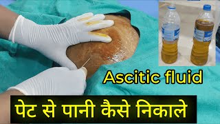 Ascites Fluid tapping Procedure  Dr Subodh SKP [upl. by Ordnael]