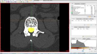 Materialise Mimics and 3Matic Tutorial [upl. by Coryden]